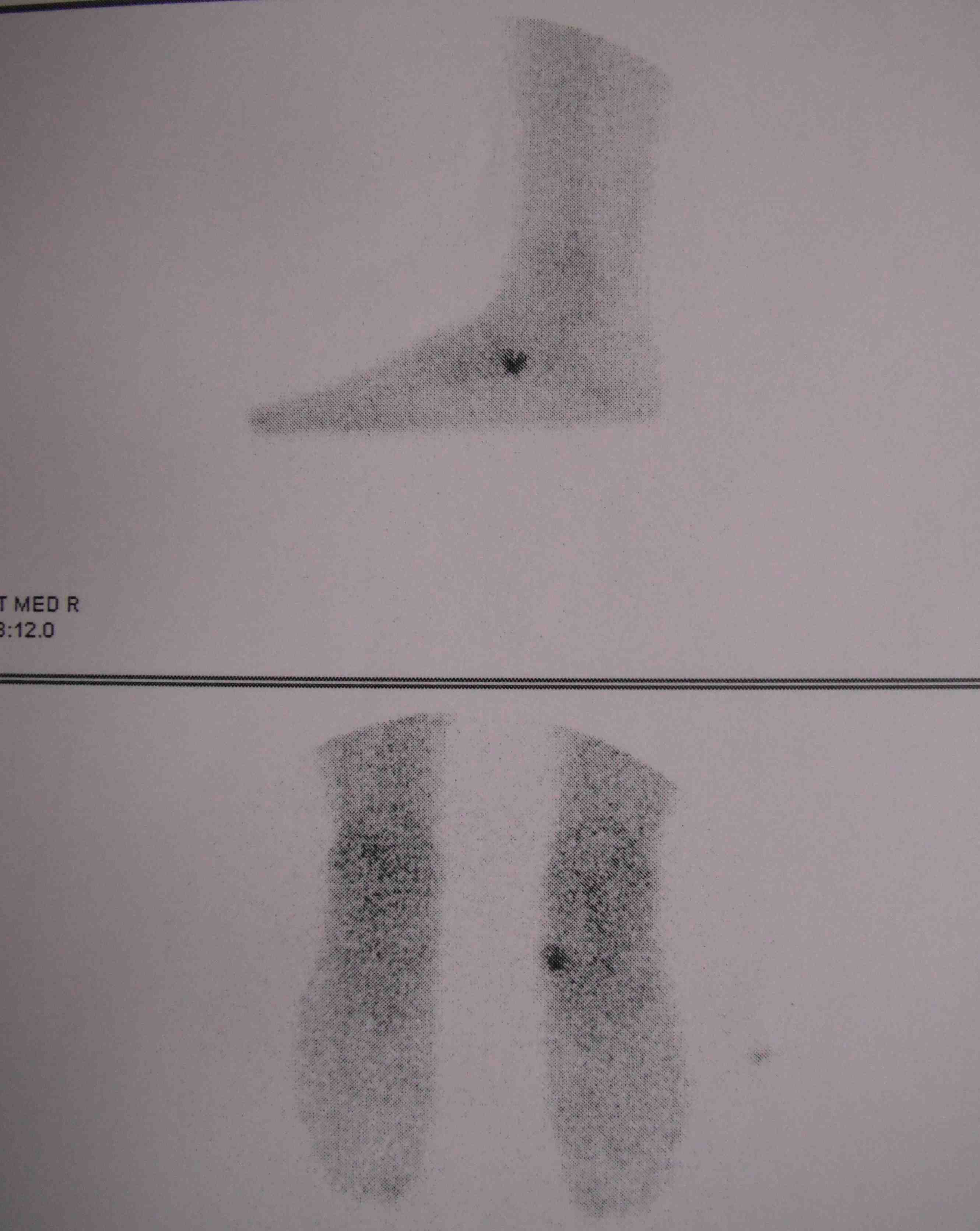 Acessory Navicular Bone Scan